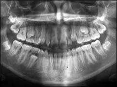 Les maladies des gencives